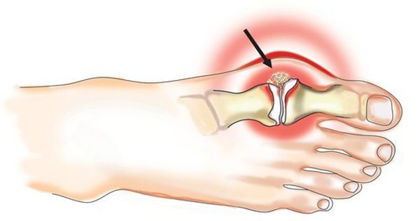sąnarių skausmas po 50 reiškia alkūnės sąnario artrito artrito