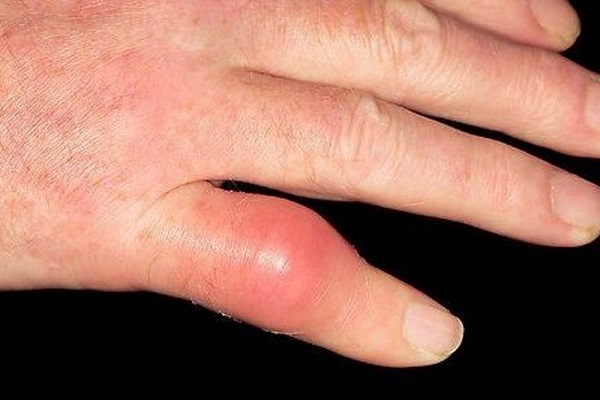 gydymo artritas šepetys rankas namuose
