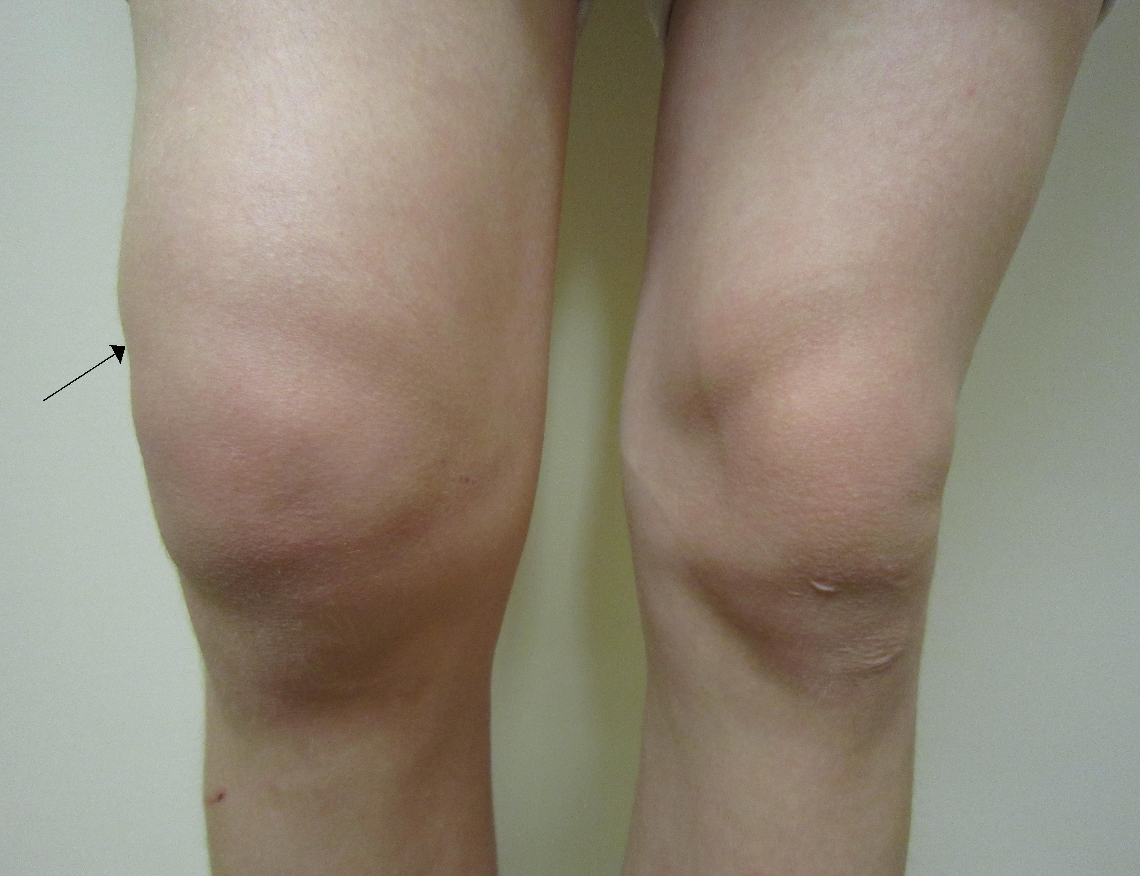 edema in knee joint jei pirštas sąnarių skausmai