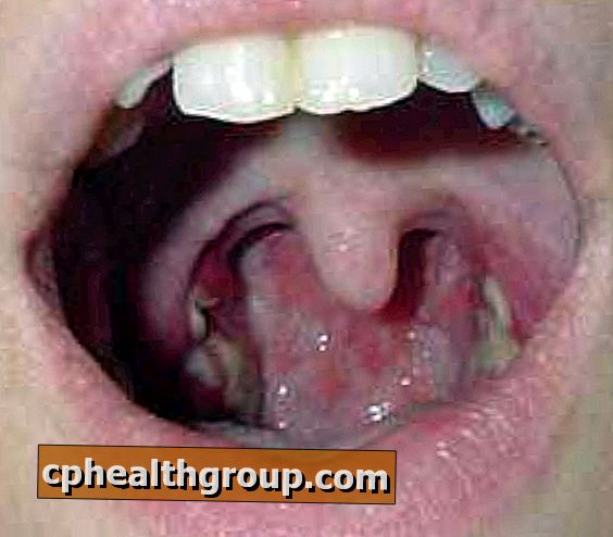 lėtinis skausmas tonsillic