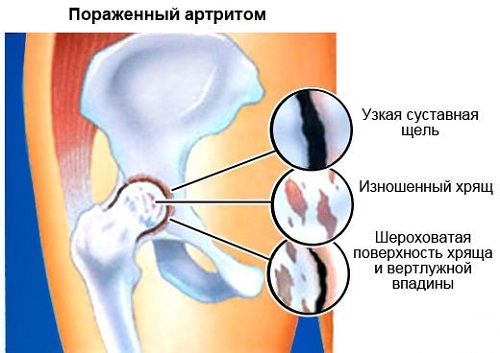 skausmas alkūnės sąnario pateiktas teptuku osteoartritas sustav gydymas