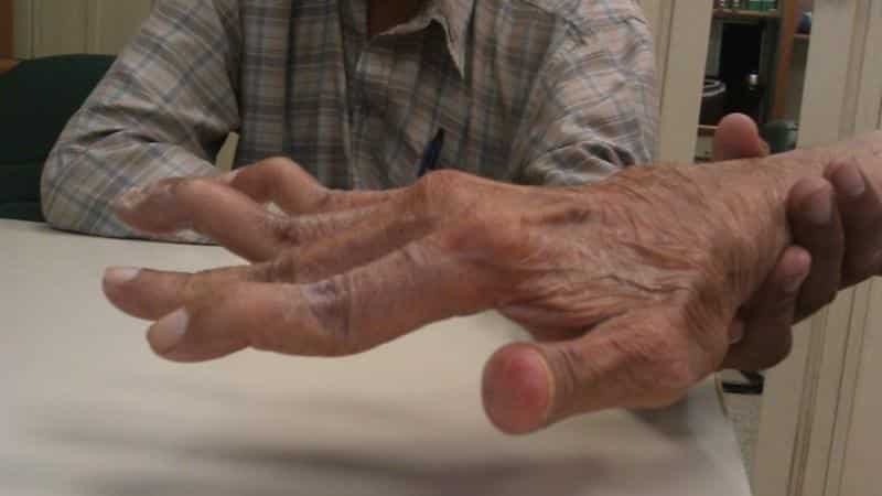 reumatoidinis artritas pečių sąnarių