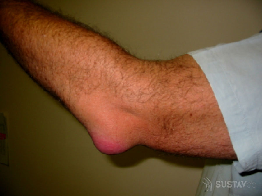 surbing sąnarį į kairės rankos alkūnės kaip artritas sąnarių pasireiškia