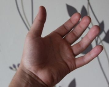 gerklės sąnarių ant dešinės rankos pirštų artrozės gydymas 1 pirštų koja
