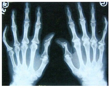 gydymas artrozė kojų nacionalinės medicinos