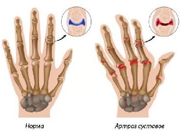gydymas artrozės ir rankas rankas liaudies gynimo gydymo falangie sustava