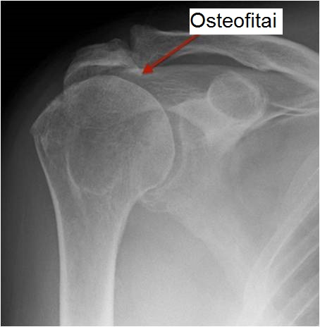 gydymas osteoartrito ir artrito peties sąnario