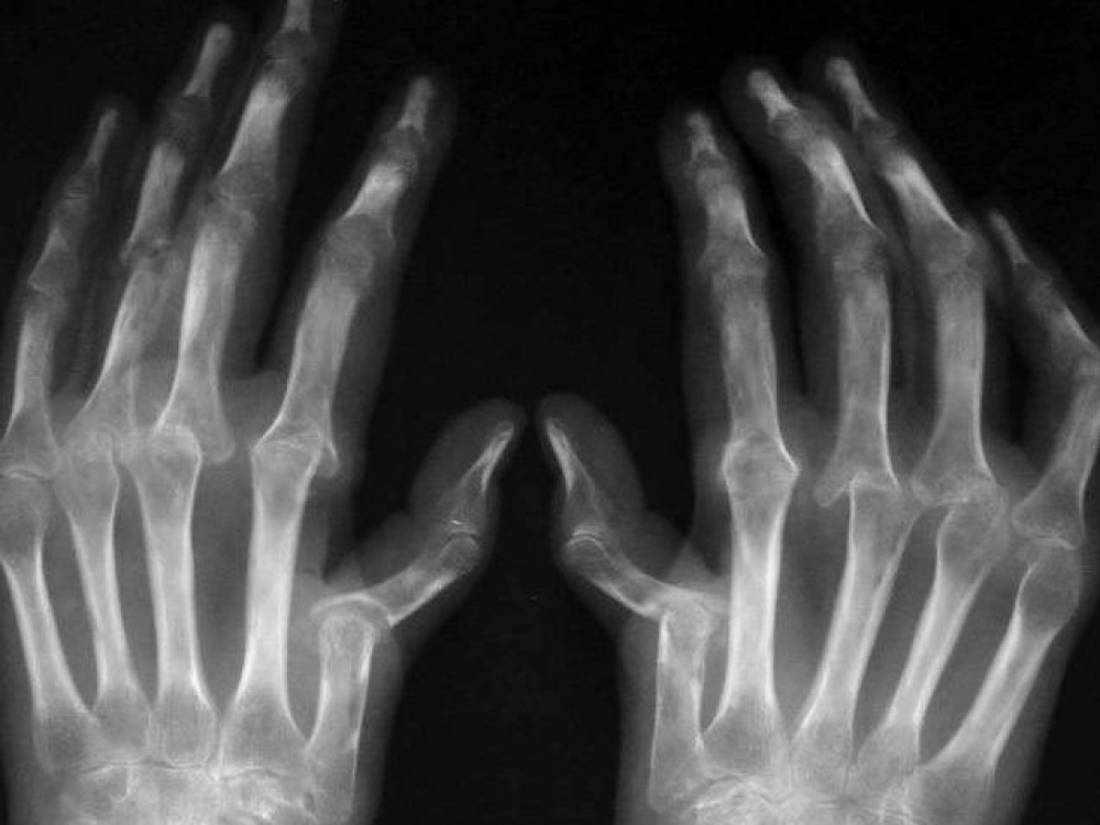 kaip nuraminti artritas ant rankų