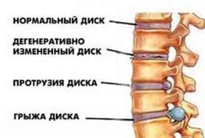 artrozė 2 etapai pečių sustain