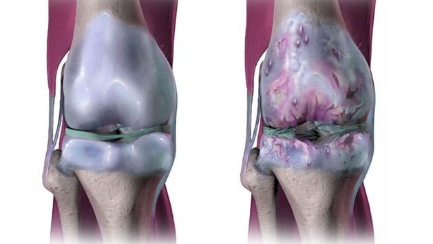 artrozė kojų gydymas kremas jei sąnariai skauda ant pėdos