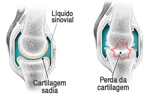 osteoartrito artrito ir bursito ar sergantys sąnarius nuo nervų