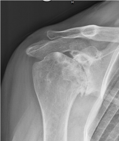 osteopata su artrozės peties sąnario įrankiai iš skausmas rankas rankų sąnarių