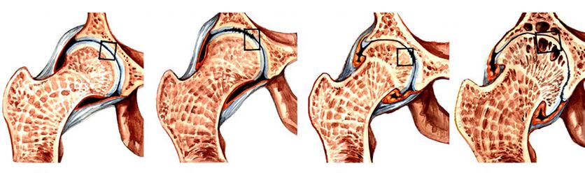 ozokeritas gydymas artrozės osteochondrozė žasto sąnario blokados