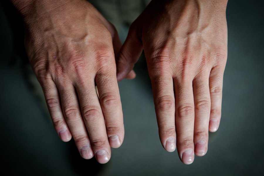 rankos pirštai tabletės su alkūnės sąnario gydymo