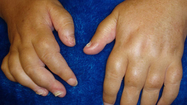 swelling joints finger skausmas dešinėje peties sąnario priežastis