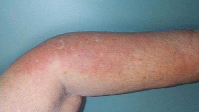 swollen painful joints and rash