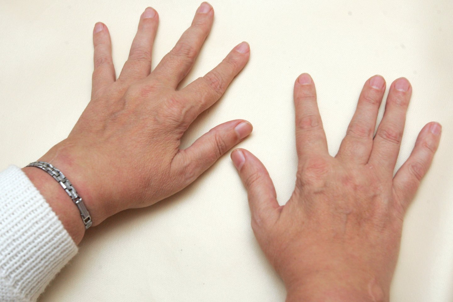 artritas pirštai gydymas tradicinė medicina