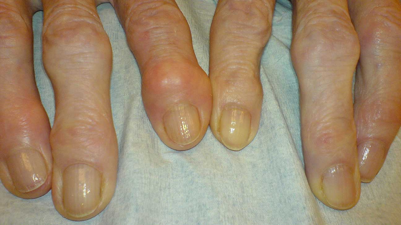 swelling joints finger pragariškas skausmas į savo rankas sąnarių