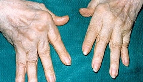 ligos nuo pirštų sąnarių artrozė kulno gydymas namuose
