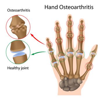 gydymas osteoartrito artrito tradicinius metodus gelis sąnarių skundą