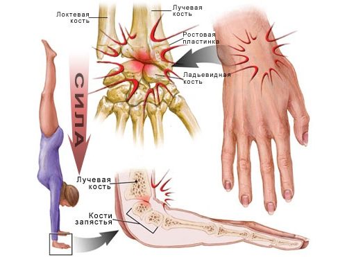 skausmas bendrų rankų šepečiai priemonė sustav