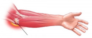 raumenų skausmas alkūnės sąnarių kai peties sąnario artrozė yra traktuojami