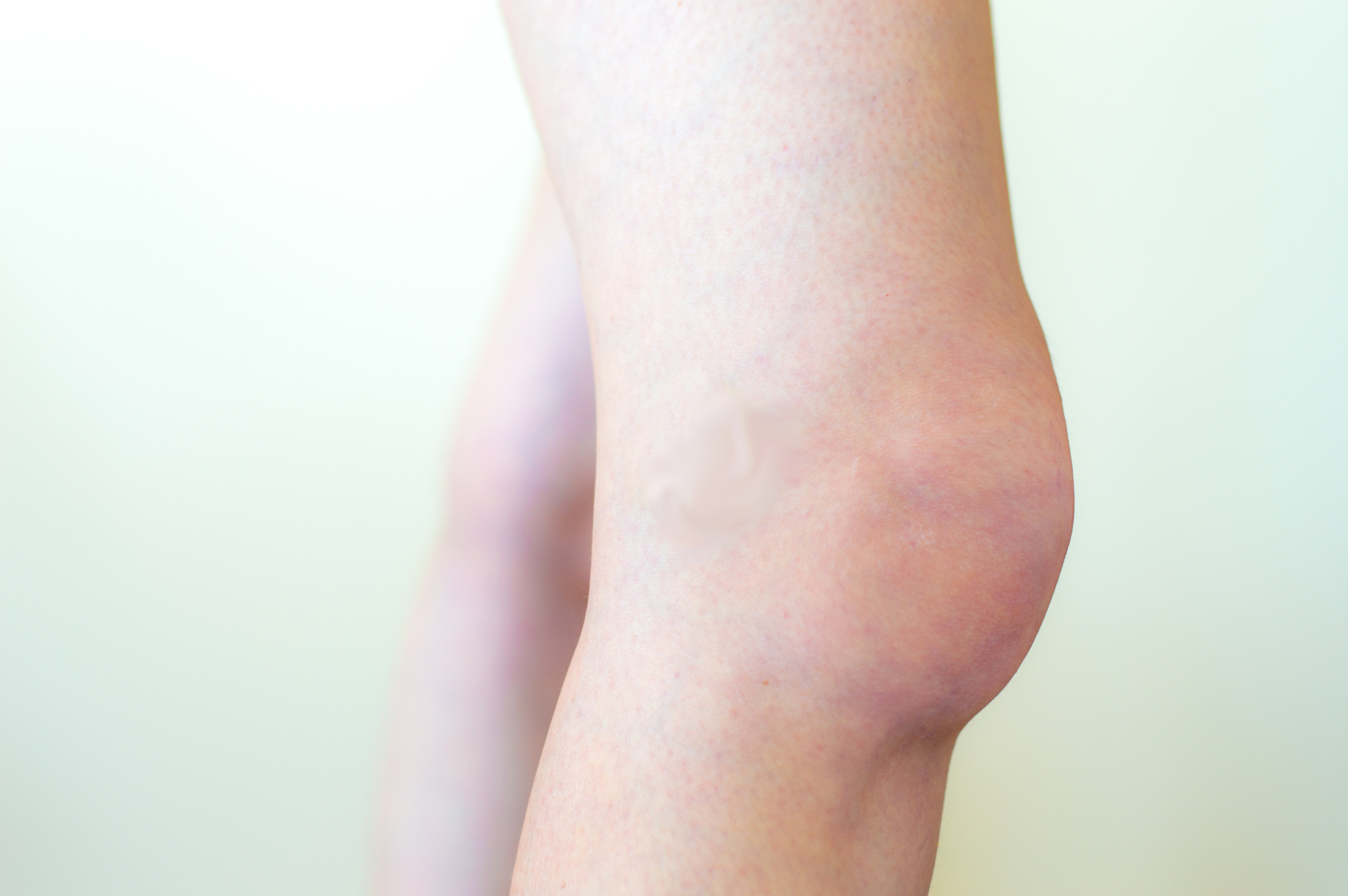 edema in knee joint nutri bangų raiščių ir sąnarių gelis