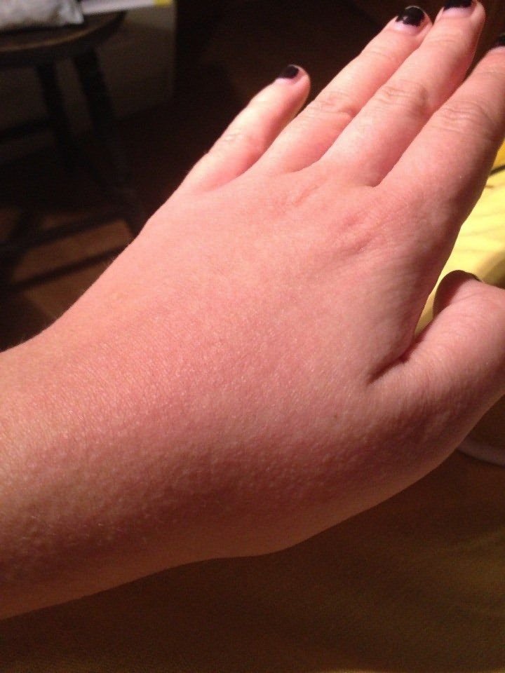 pradėti sąnarius ant rankų pirštų amoxiclav iš sąnarių skausmas