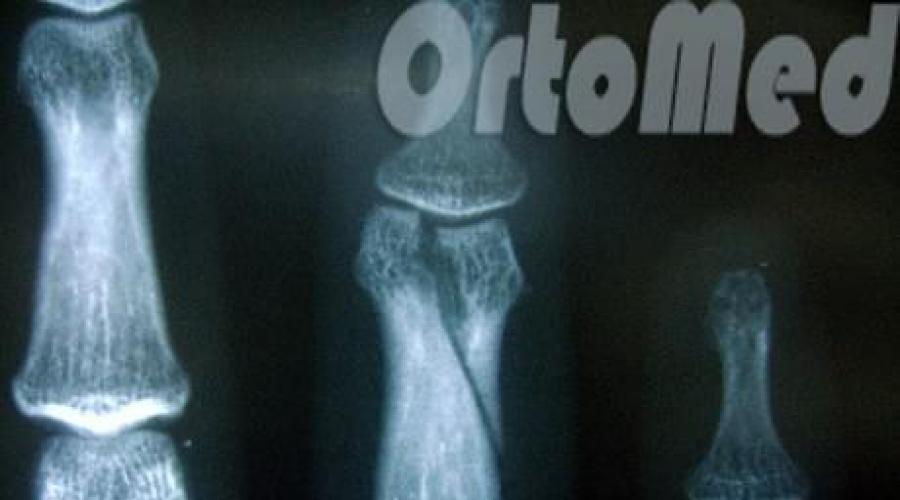 gydymas osteoartrozės nuo šepetėliai rankų sąnarių