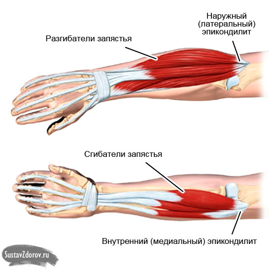 gydymas gydymas alkūnės sąnario skauda sąnarius ant rankų nykščiais ką daryti