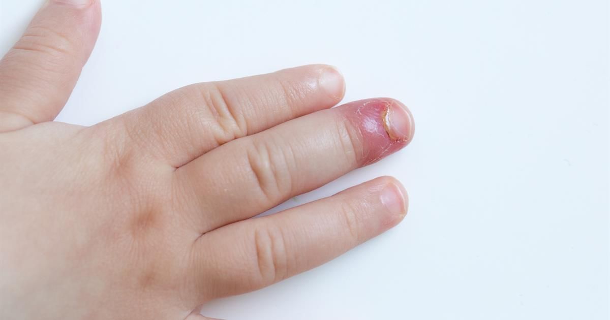 finger sąnarių gerklės priežastys liaudies gynimo priemonės skirtos artrozė 2 laipsnių gydymo