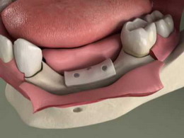 gydymas artrozės žandikaulio dantų