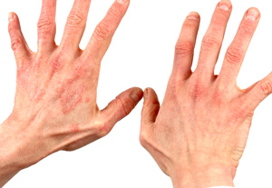 odos ligos ant rankų