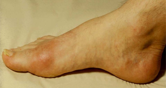 podagra krankheit artrozės 3 laipsnių pėdos gydymas