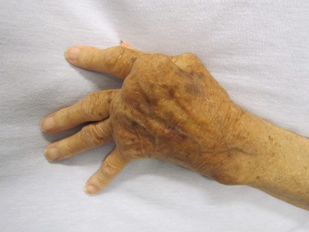 edema in rheumatoid arthritis sužeistas į sąnarius pirštus ant ką rankose jis
