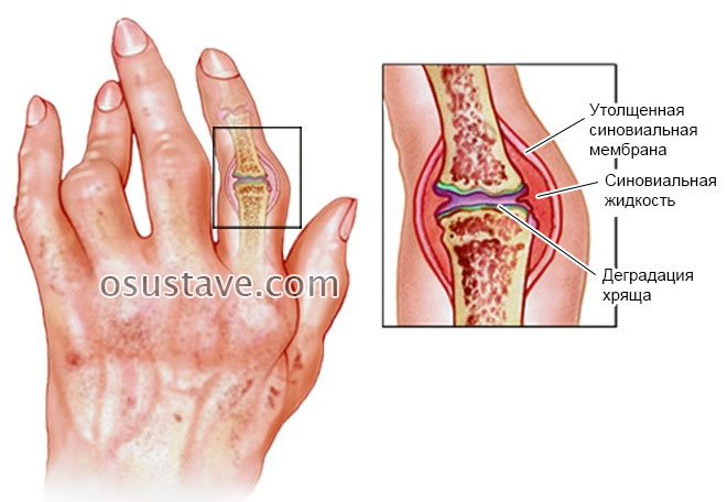 gydymas artrozė 1 piršto pėsčiomis priežastis dėl sąnarių skausmo ant rankų pirštų