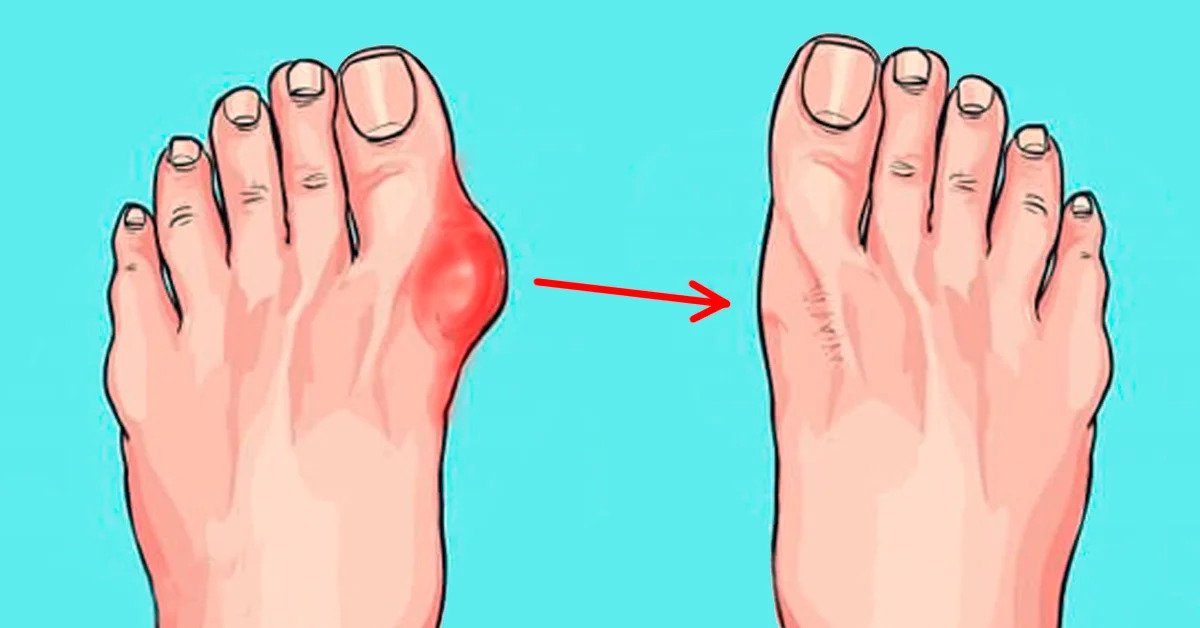 hurt nykščio sąnarį ant pėdos gydymas sąnarių populiarus būdas