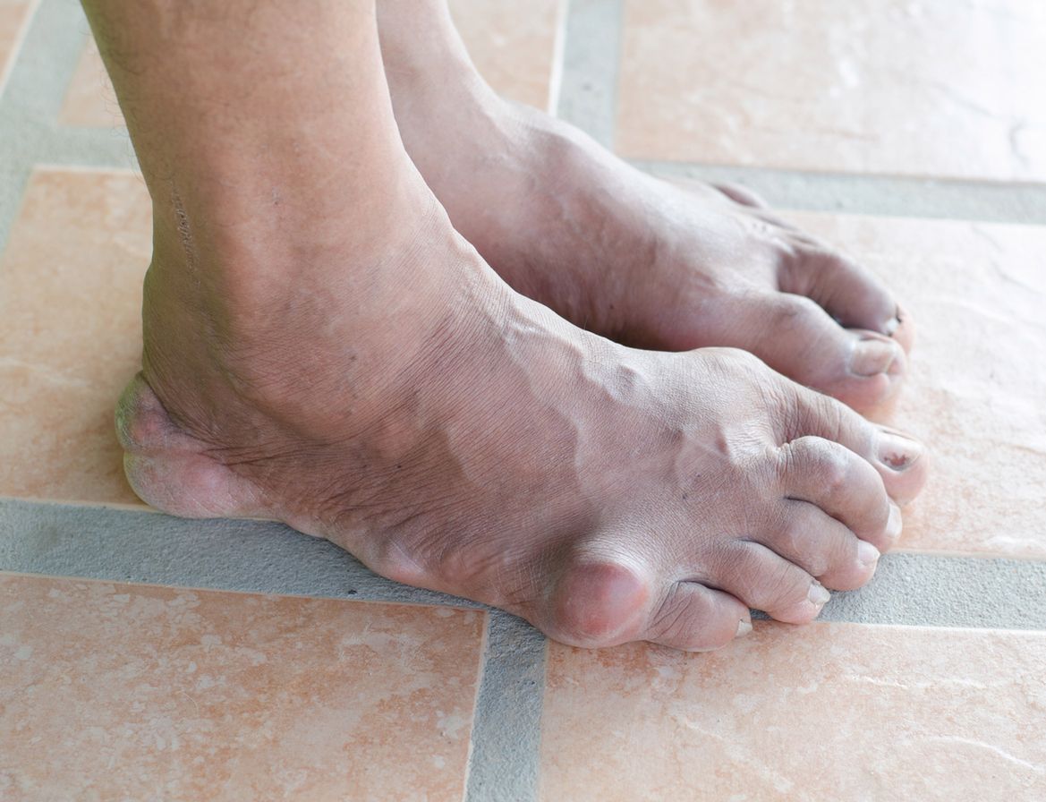 artritas ir artrozė iš pėdos sąnarių augalai artrozės gydymas