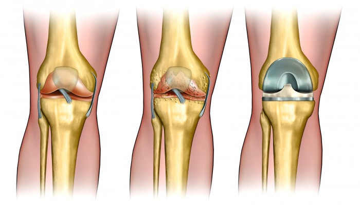 išlaikyti ligų kojas tepalas nuo skausmo apatinėje nugaros ir sąnarių