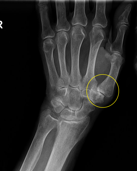 artrozė iš pėdos pirštų sąnariai karbamido sąnarių skausmas
