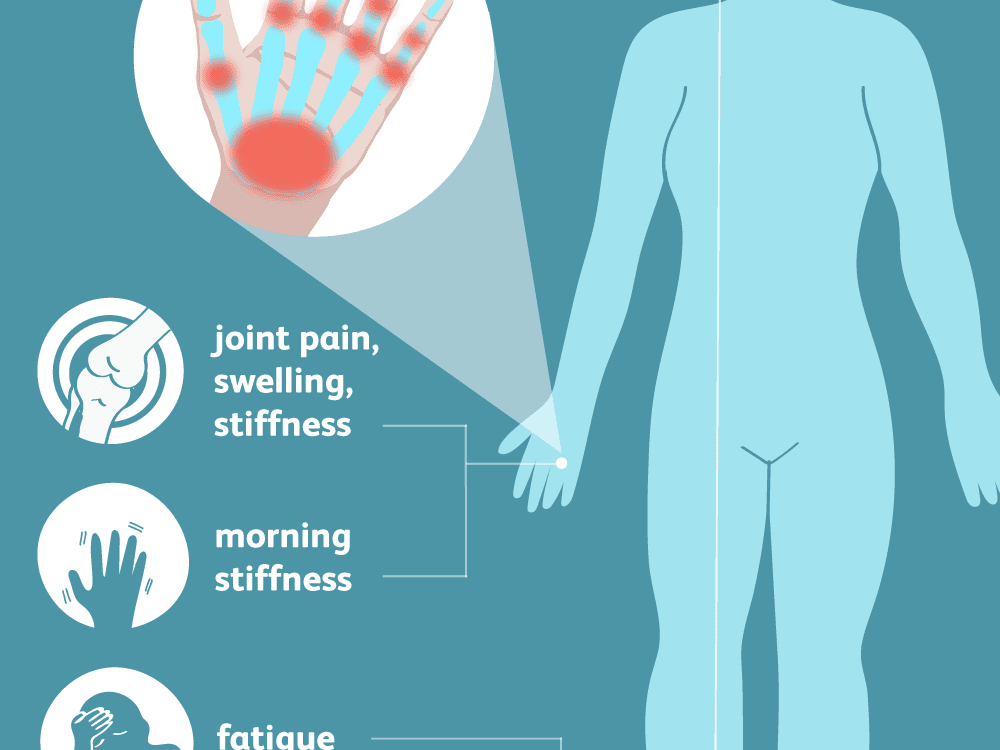 kaip gydyti artrozės