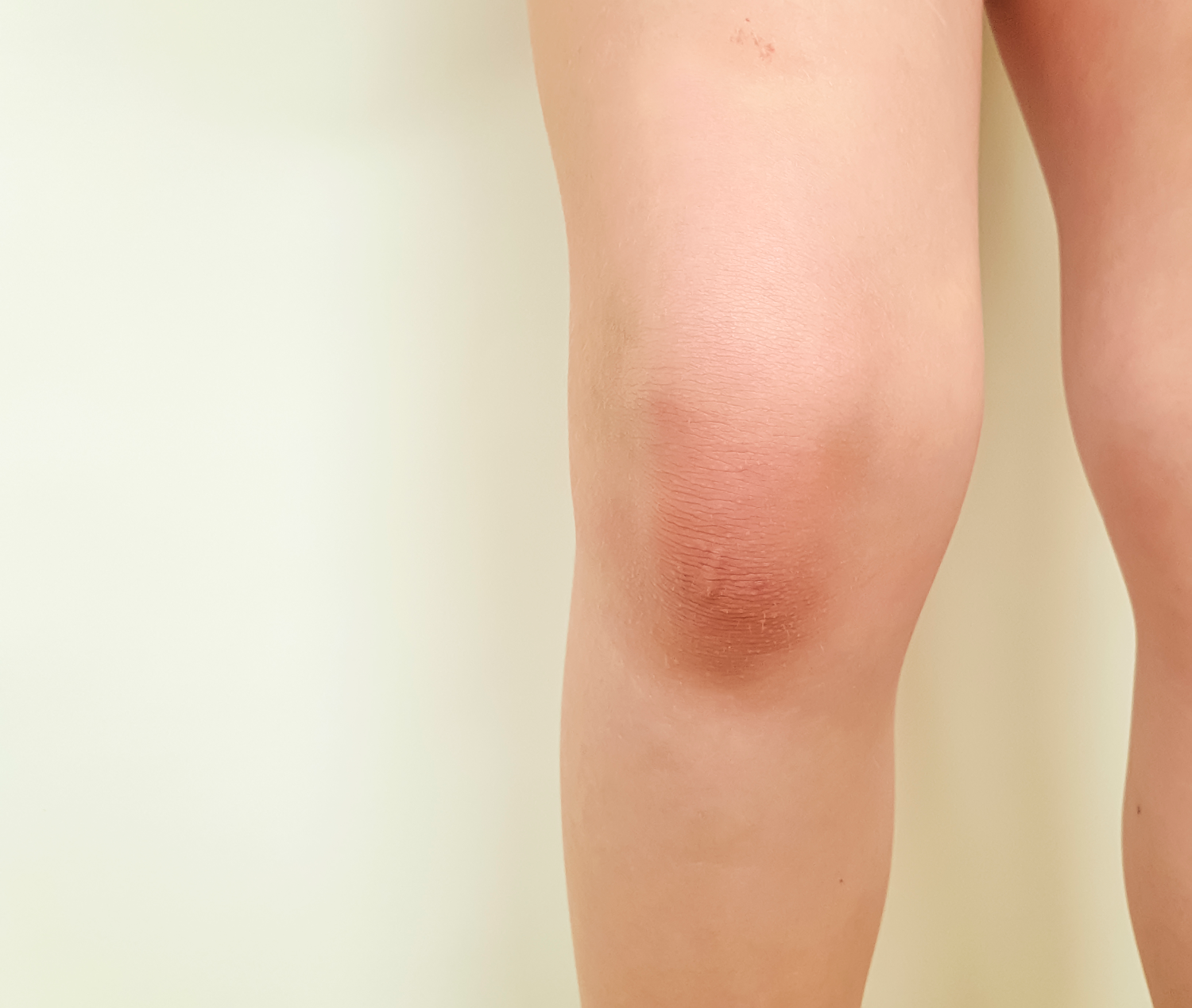 edema in knee joint kremas sąnarių gydymo