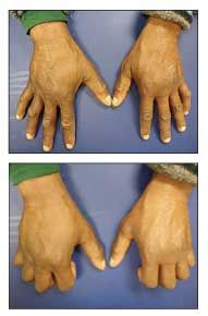 edema in rheumatoid arthritis prevencija iš peties sąnario traumų