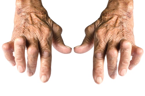ką daryti artritu rankas