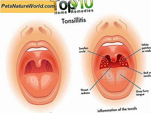 lėtinis skausmas tonsillic