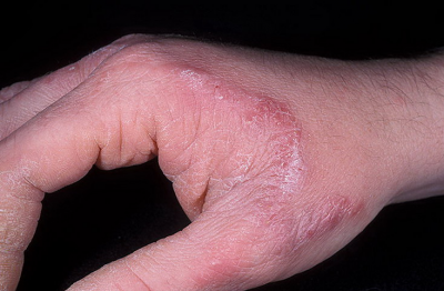 odos ligos ant rankų