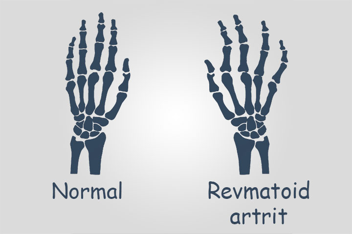 kontūras gydymas artritas rankų
