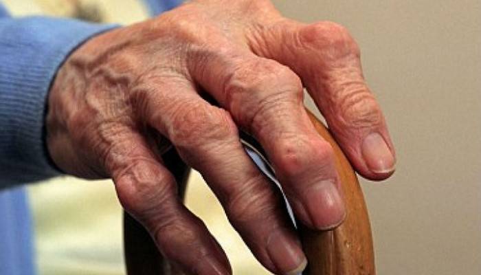 požymiai artritas šepečių rankas