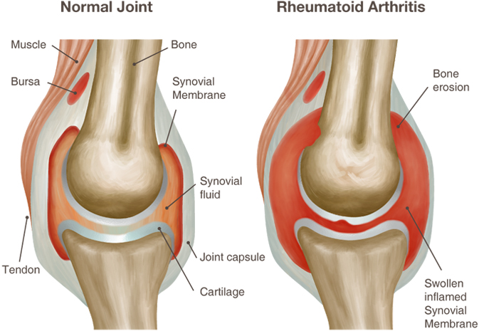 reumatoidinis artritas bendrų ligų