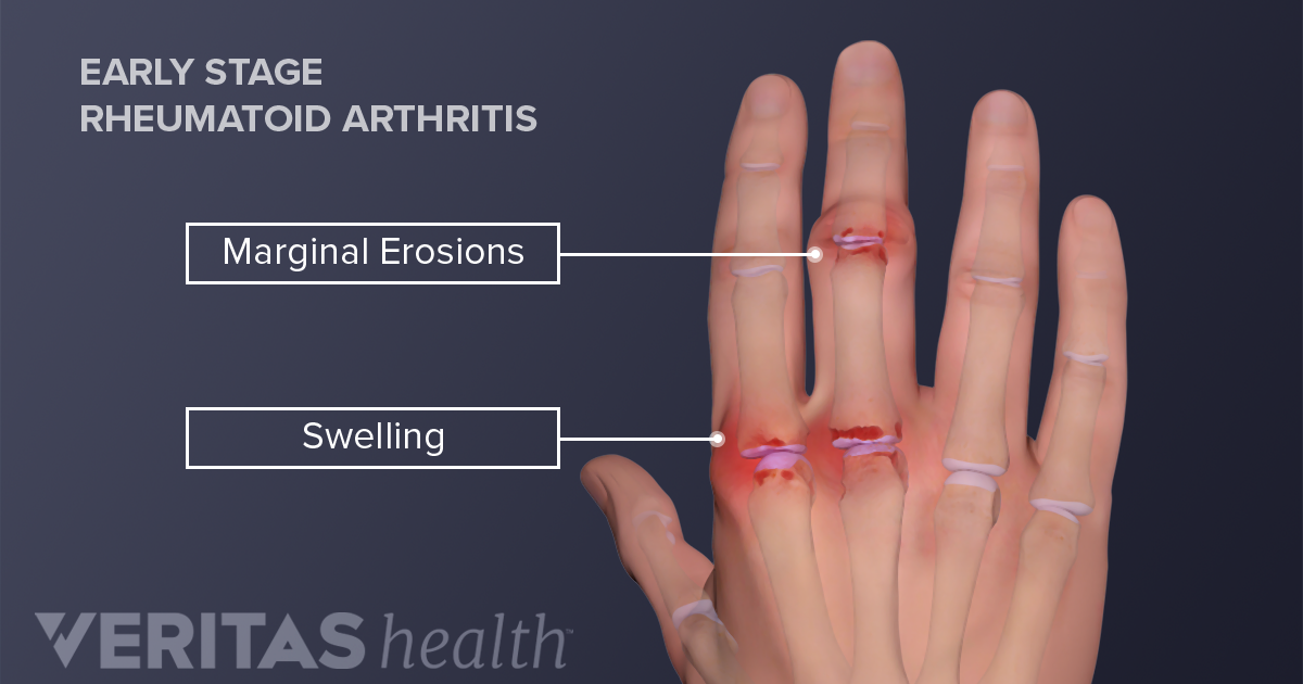 swelling joints finger skausmas pečių ir alkūnės sąnario dešinės rankos priežastis